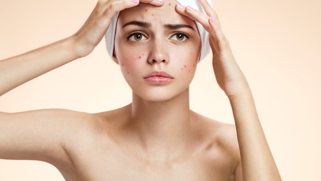 Remove Pimples Naturally: 7 Powerful Home Remedies That Actually Work