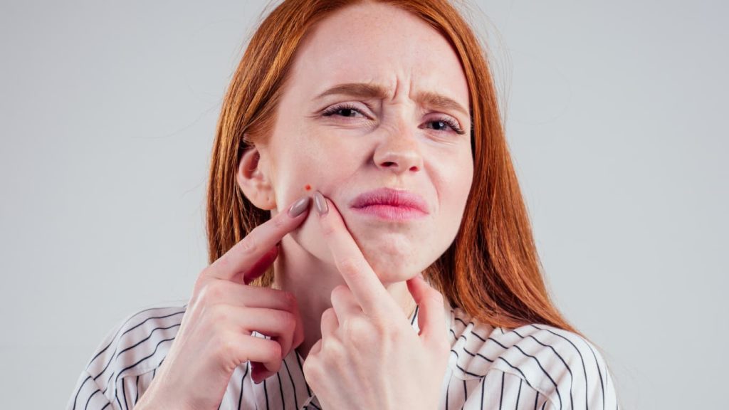 Remove Pimples Naturally: 7 Powerful Home Remedies That Actually Work