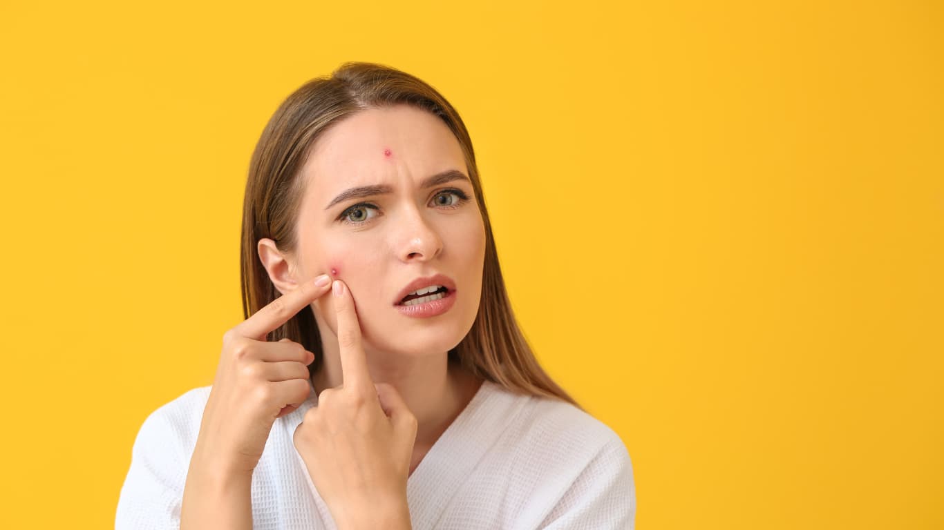 Remove Pimples Naturally: 7 Powerful Home Remedies That Actually Work