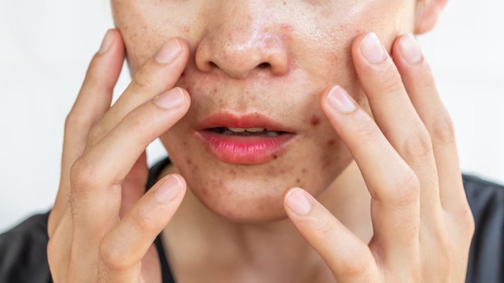 Best Bar Soap for Oily Skin