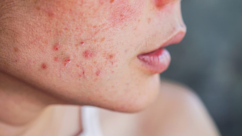 Say Goodbye to Pimples – 7 Easy Tips That Actually Work!