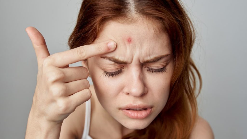 Say Goodbye to Pimples – 7 Easy Tips That Actually Work!