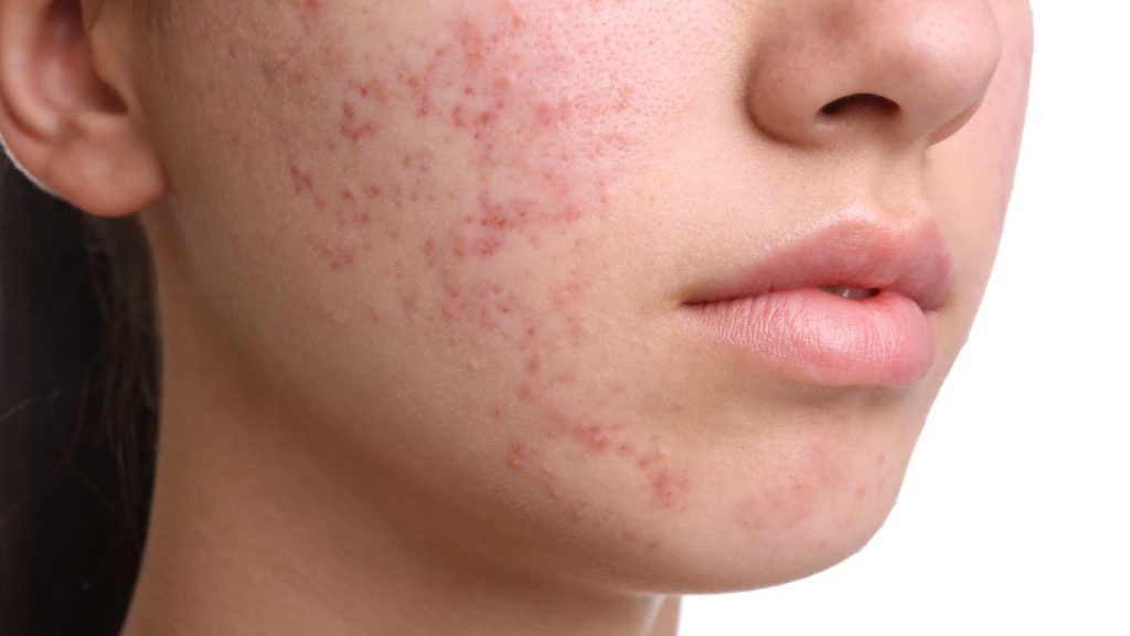 Say Goodbye to Pimples – 7 Easy Tips That Actually Work!